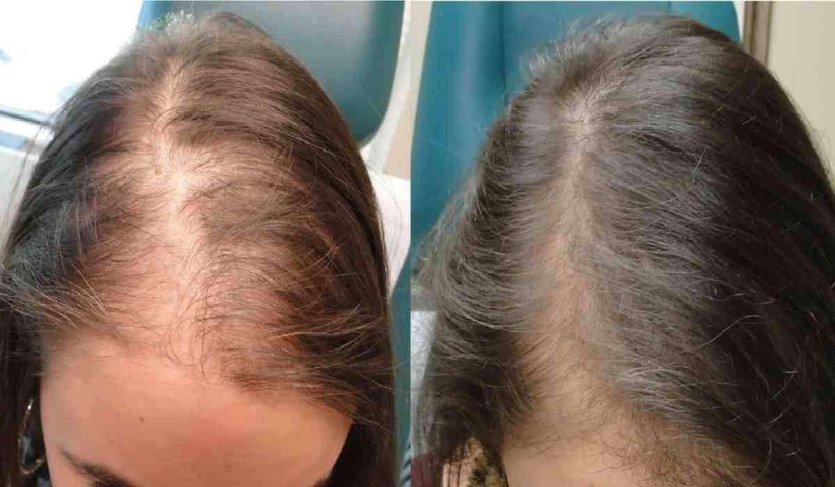 Side Effects Of Rosemary Oil On Hair